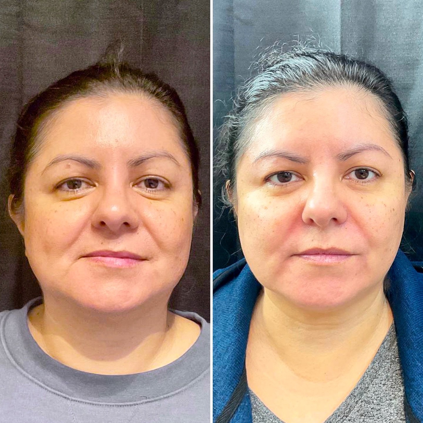 Discover Dermal Fillers at Humble Beauty