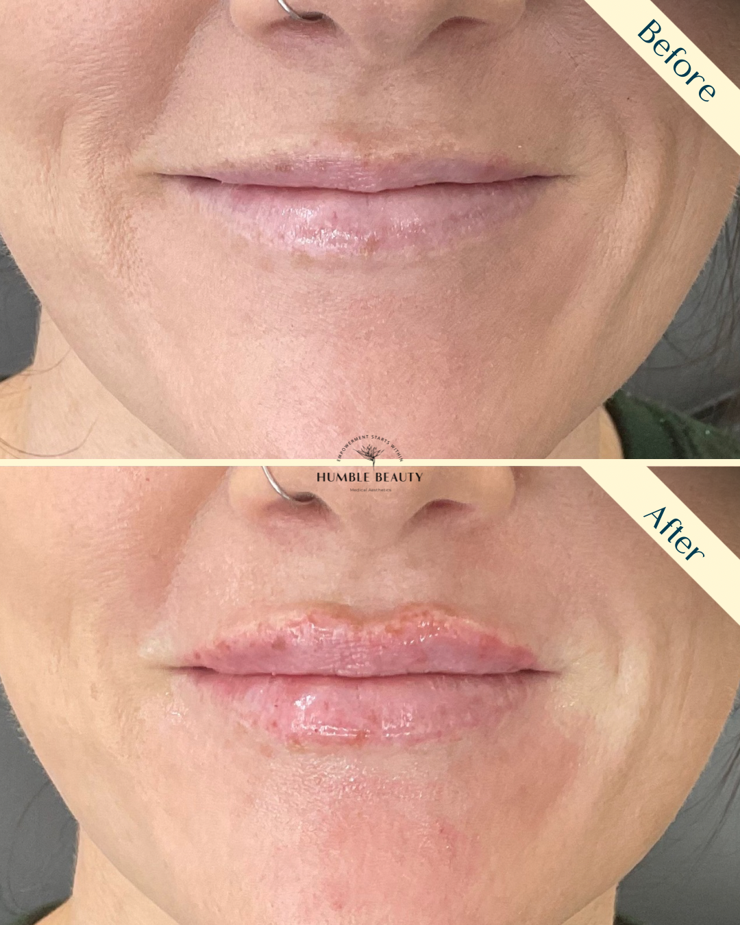 Humble Beauty, Medical Aesthetics, Kitsap, Kingston, Safe, FDA approved, botox, filler, Poulsbo, Silverdale, Bremerton, Washington, consultation, dissolve, near me, best, microneedling, tear trough, peel, Dermal filler, med spa, RN, wrinkle relax

 g