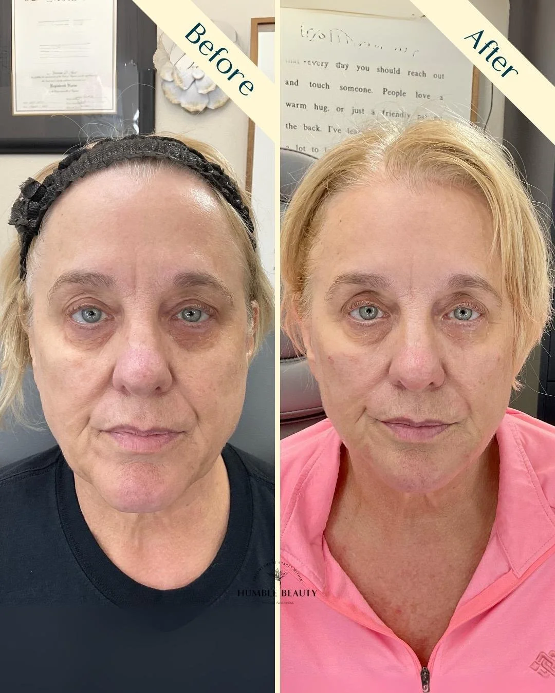 EZ gel, PRX biostimulant and microneedling with PRF