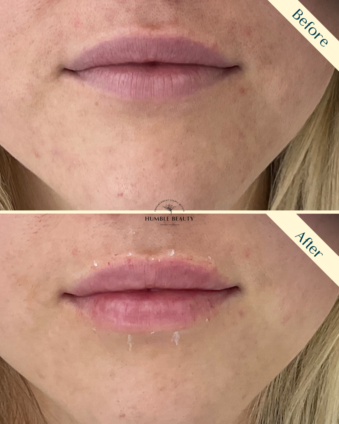 Humble Beauty, Medical Aesthetics, Kitsap, Kingston, Safe, FDA approved, botox, filler, Poulsbo, Silverdale, Bremerton, Washington, consultation, dissolve, near me, best, microneedling, tear trough, peel, Dermal filler, med spa, RN, wrinkle relax

 g