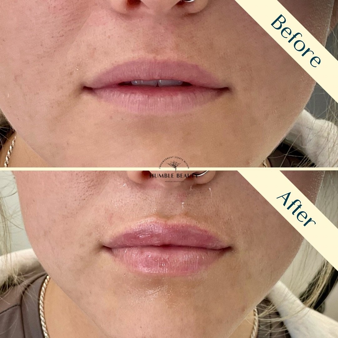 Humble Beauty, Medical Aesthetics, Kitsap, Kingston, Safe, FDA approved, botox, filler, Poulsbo, Silverdale, Bremerton, Washington, consultation, dissolve, near me, best, microneedling, tear trough, peel, Dermal filler, med spa, RN, wrinkle relax

 g