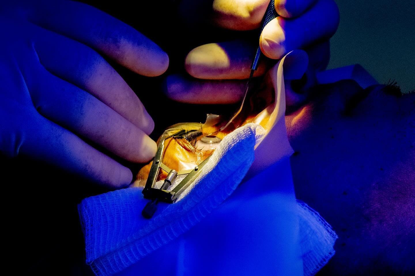 Horizontal outtakes from my latest piece for @wsj photographing Keratopigmentation surgery, the $12k procedure to change your eye color. 

Acting similar to lasik, a laser creates a canal on top of the cornea to pave a path for colored pigment, like 