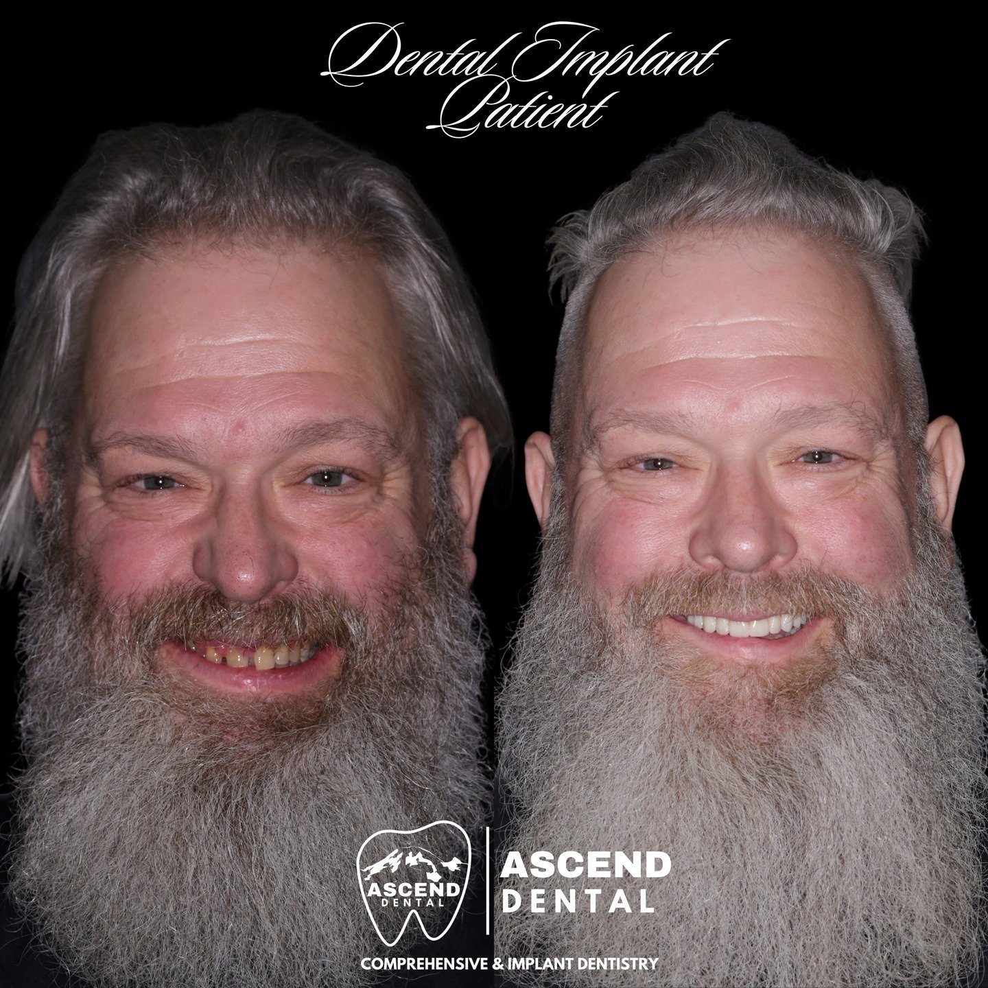 An incredible change for an awesome patient! What a huge transformation! He is now able to eat the foods he enjoys pain free! 🦷🔥

Looking for a long term solution to broken, missing, or painful teeth? We can help! Let's get you back to enjoying the