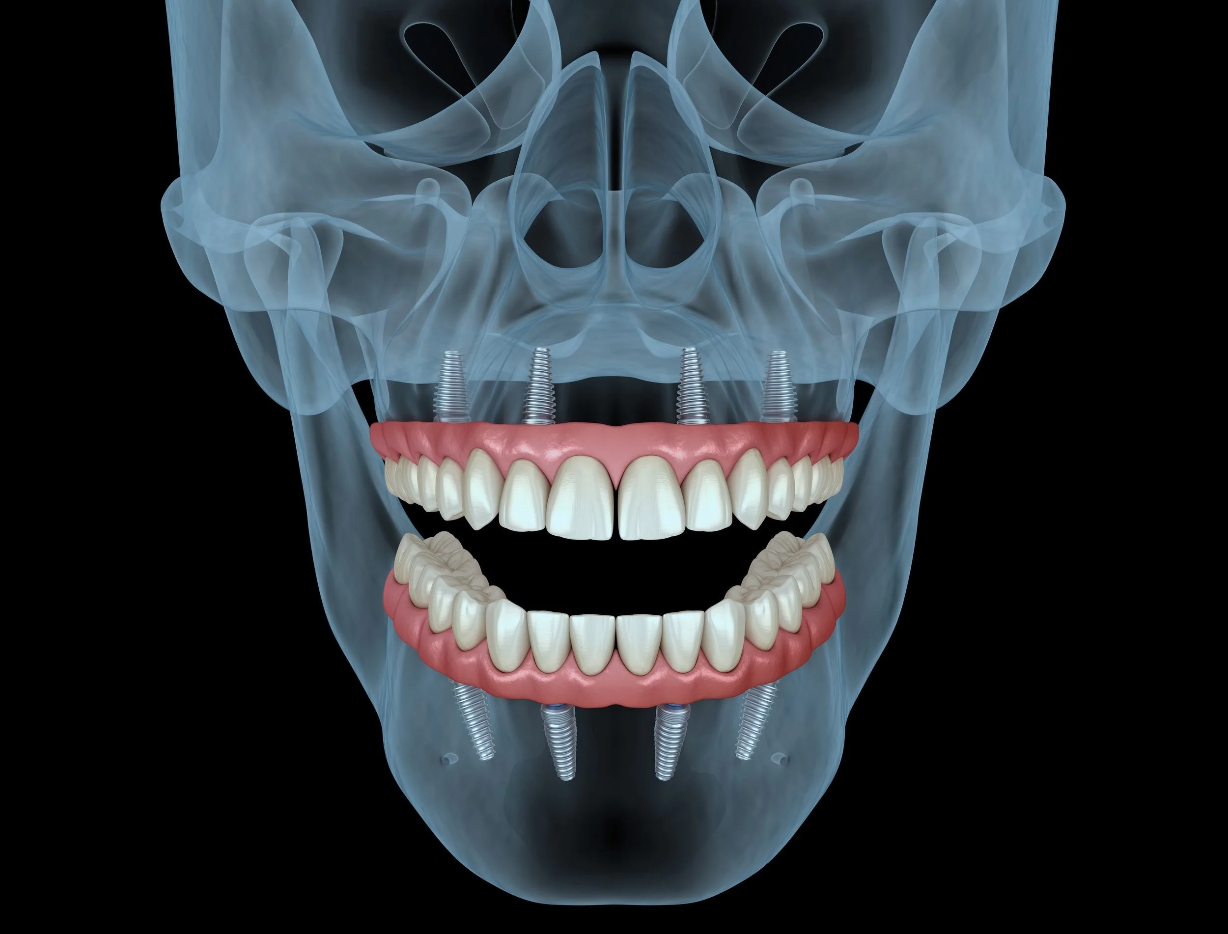 Costs For Dental Implants Puyallup Washington Costs For Dental Implants Puyallup Washington