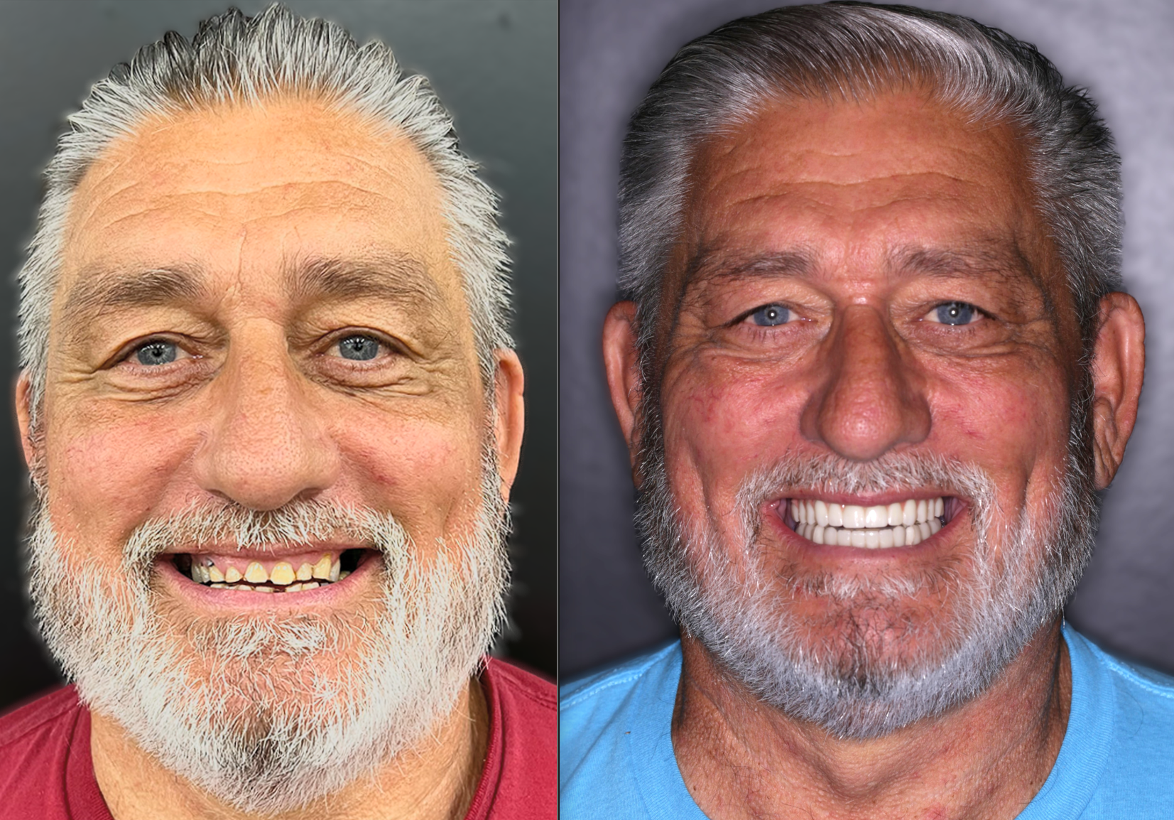 Dental implants Puyallup.png