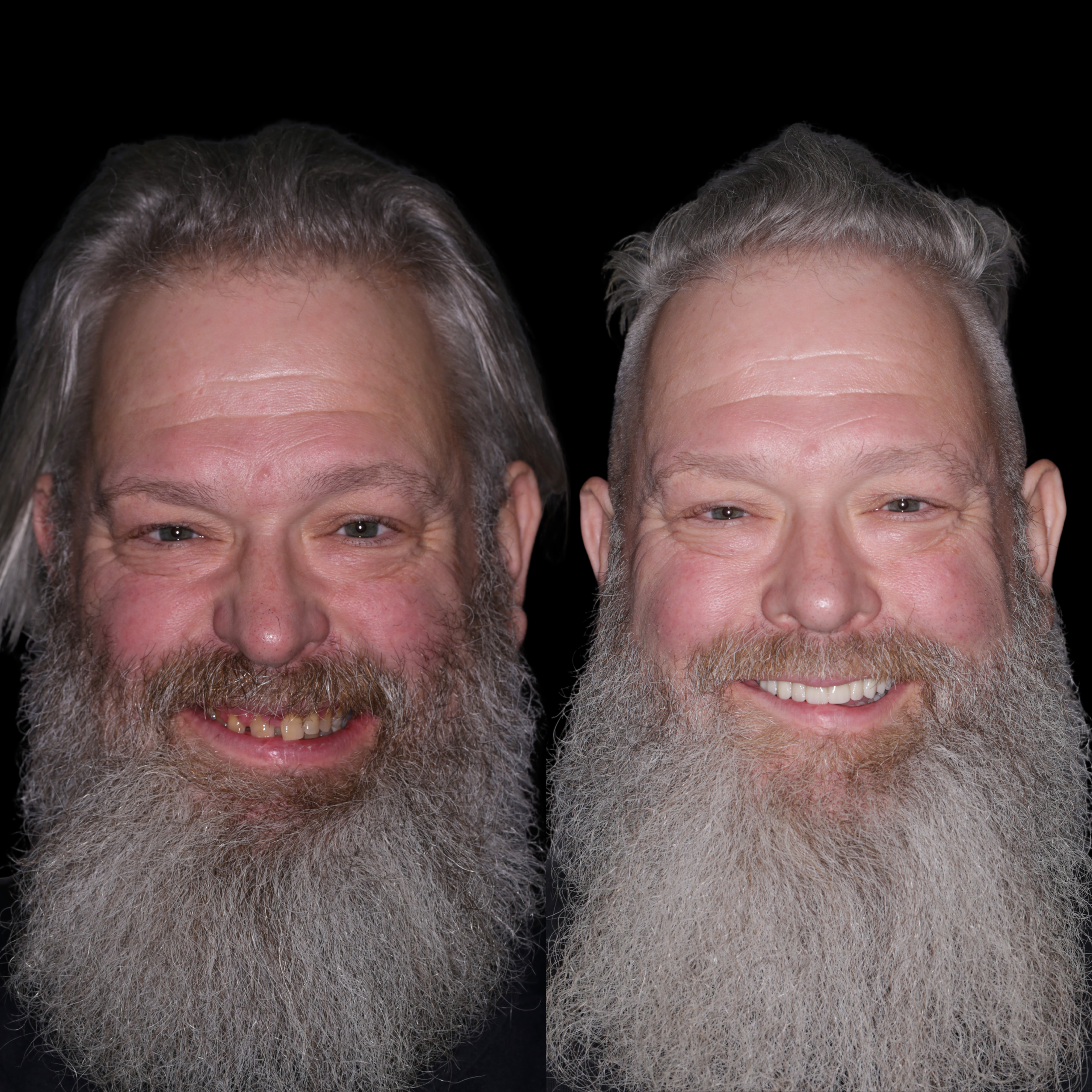 Dental Implants in Puyallup.png