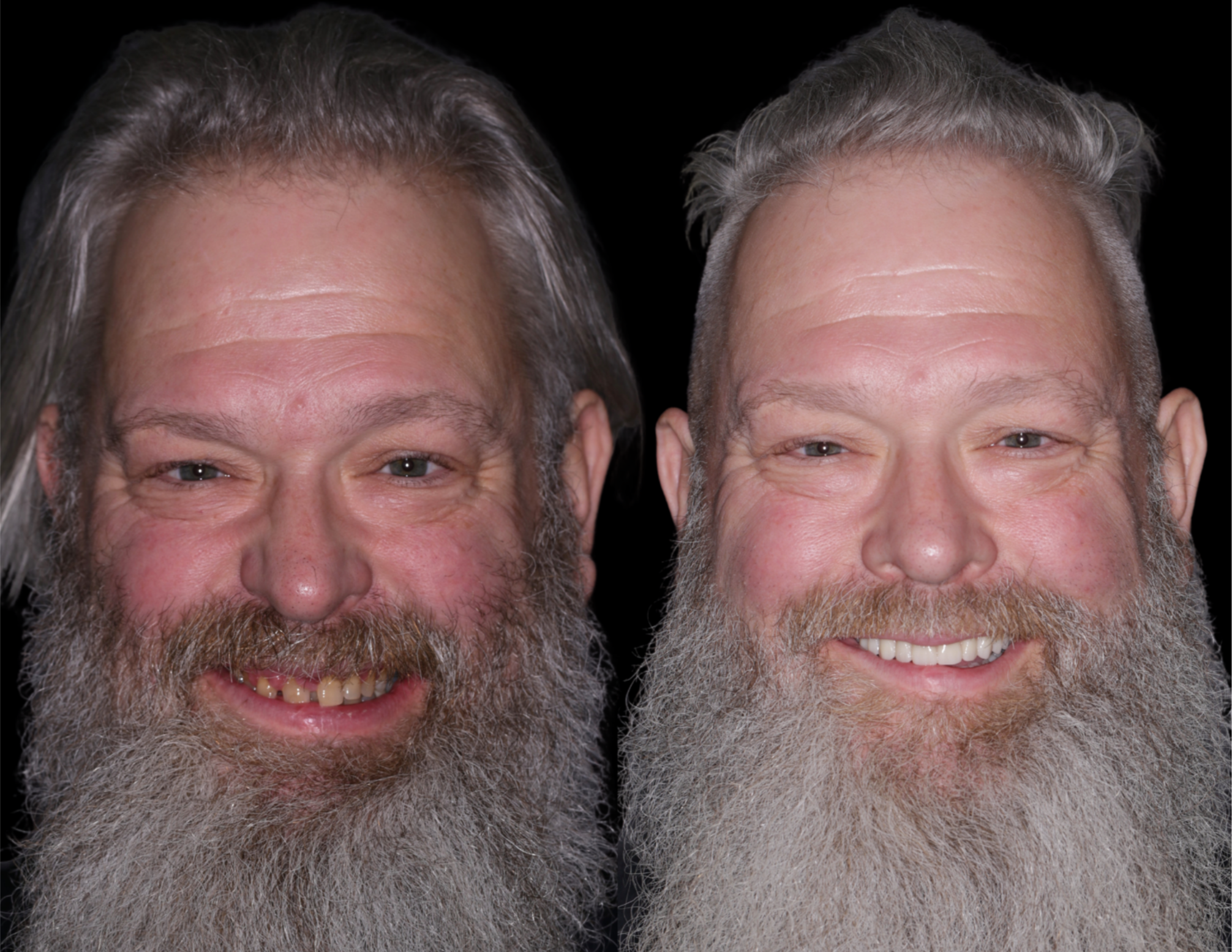 Dental Implants Puyallup