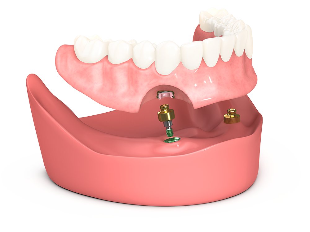 Snap in dentures Puyallup