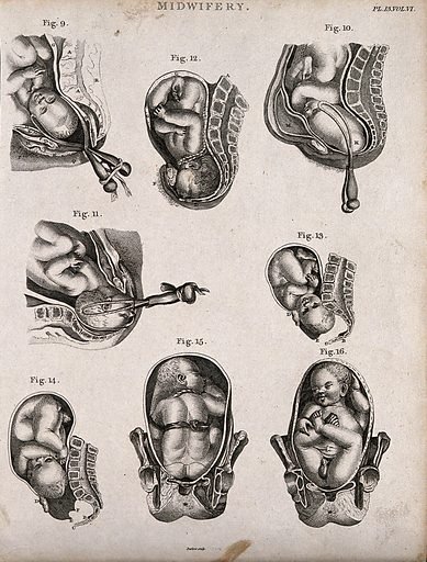 CASE STUDY : Breech 38 weeks