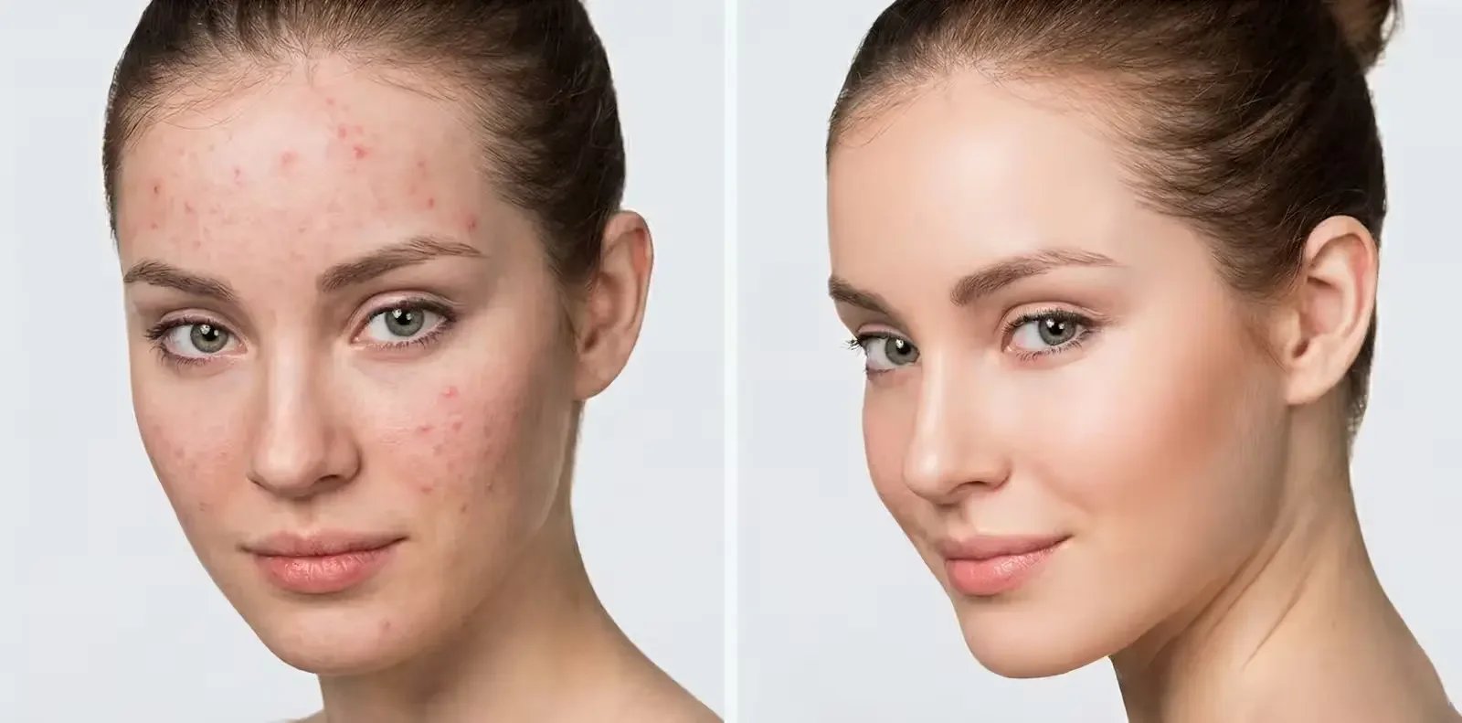 Side-by-side comparison of a woman with acne-prone skin before and after skincare treatment, showing clear, smooth skin in the after image.