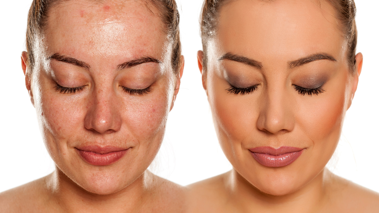 SQT Bio Microneedling Anti-Aging