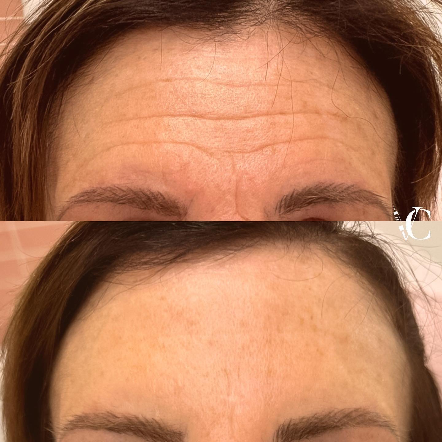 Wrinkle Reducing Treatment to the forehead area