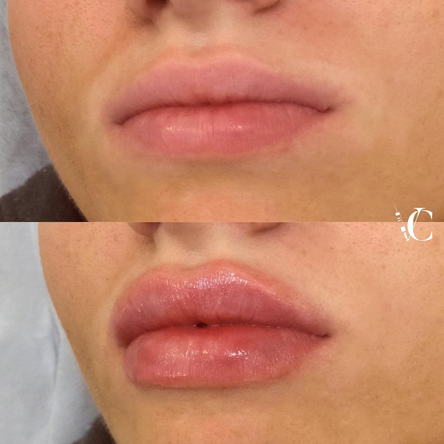 Lip Volume Enhancement Treatment
