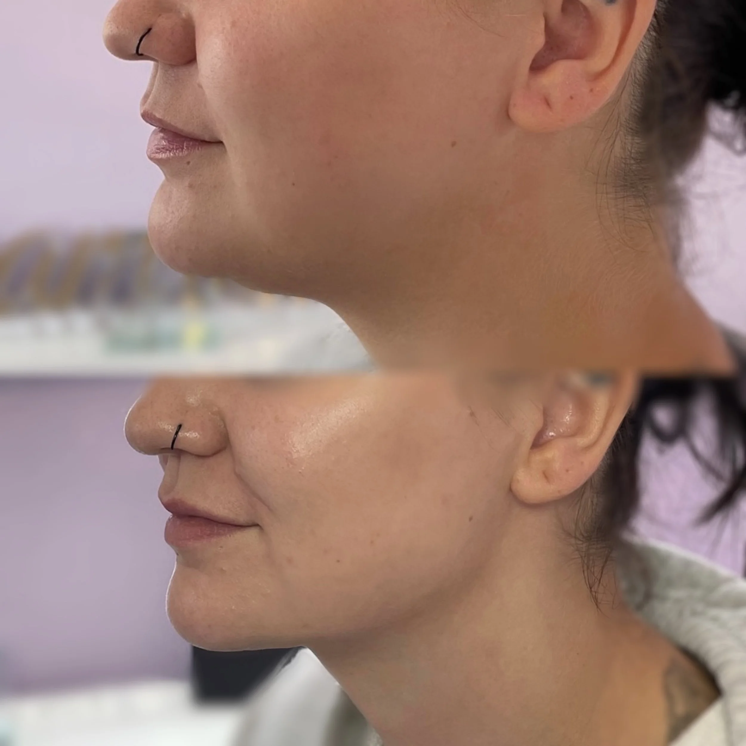 Side-by-side comparison of a woman's face before and after fat dissolving injections showing visible snatched changes in the chin and jawline area.
