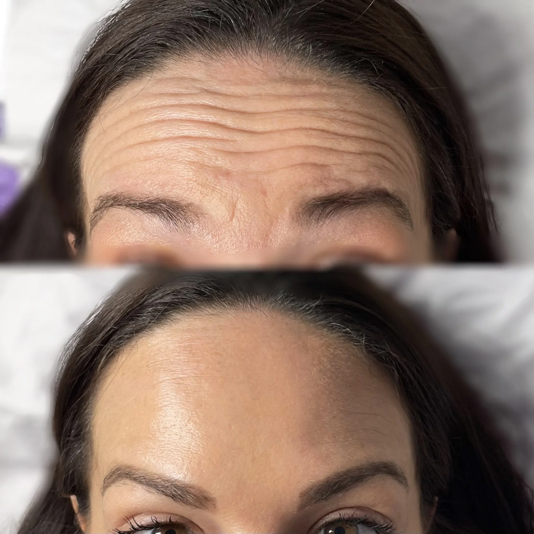 Comparison of how anti wrinkle botox works on forhead, before and after treatment. Top: Wrinkled forehead; Bottom: Smooth forehead with fewer lines.