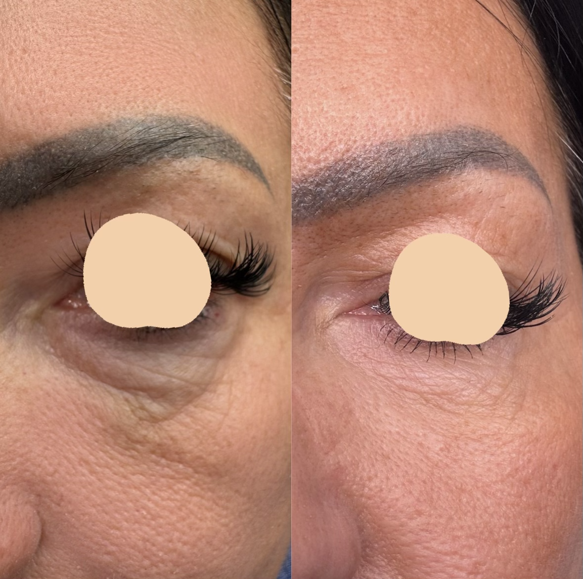 Before and after images Polynucleotides for under eye bags, showcasing improved skin appearance.