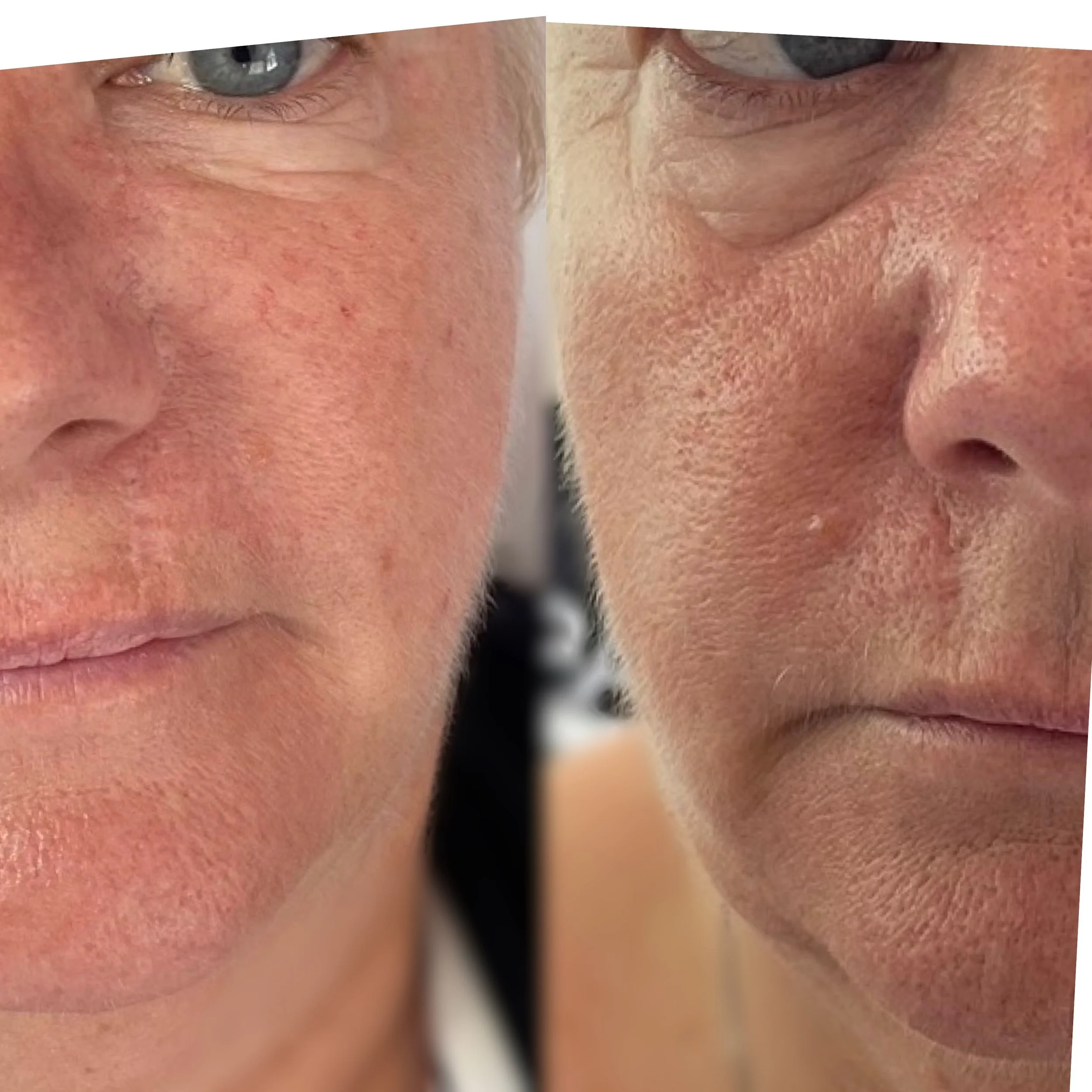 Side-by-side comparison of facial skin before and after Profhilo a skin injectable, showing differences in texture and laxity.