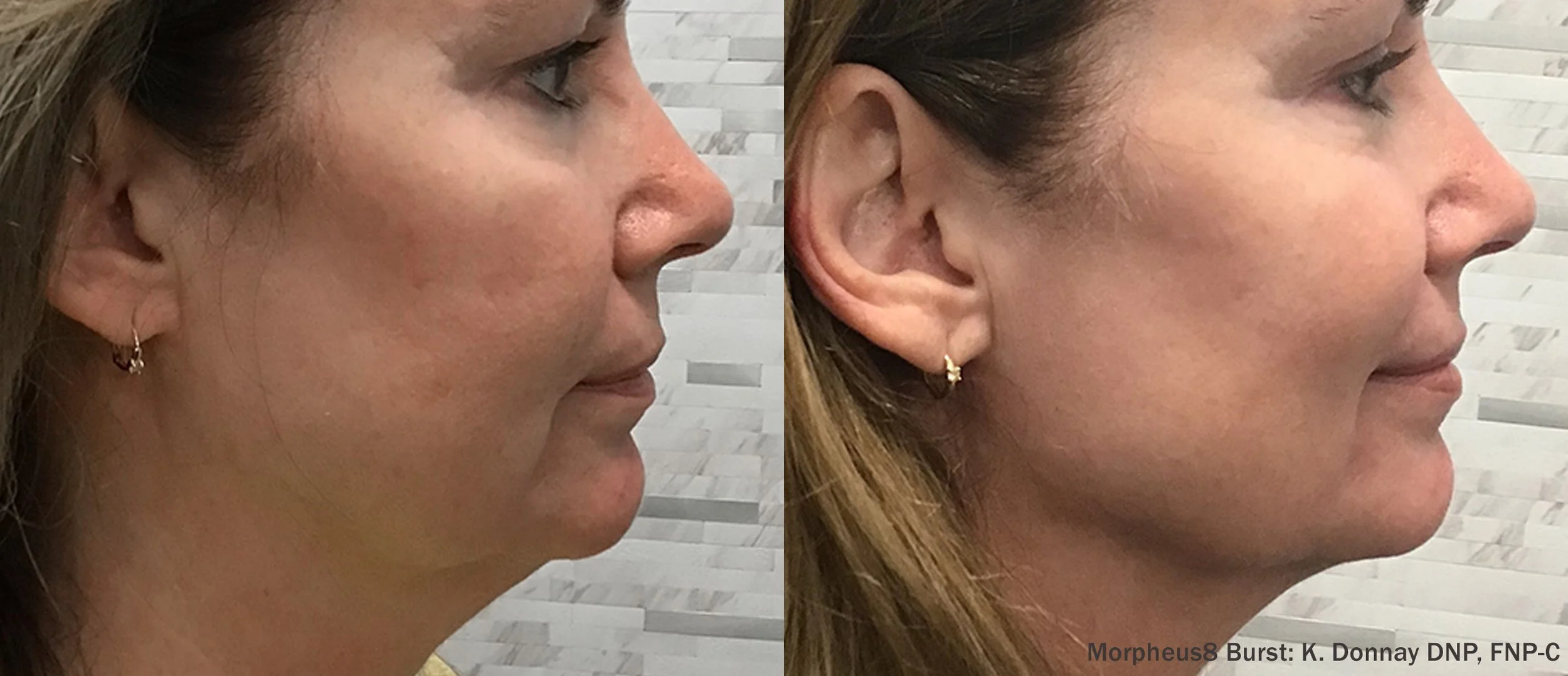 Morpheus8 wrinkle reduction before and after Raleigh NC radiant skin treatment
