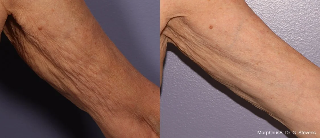 Morpheus8 body treatment before and after Raleigh NC showing firmer skin and improved texture