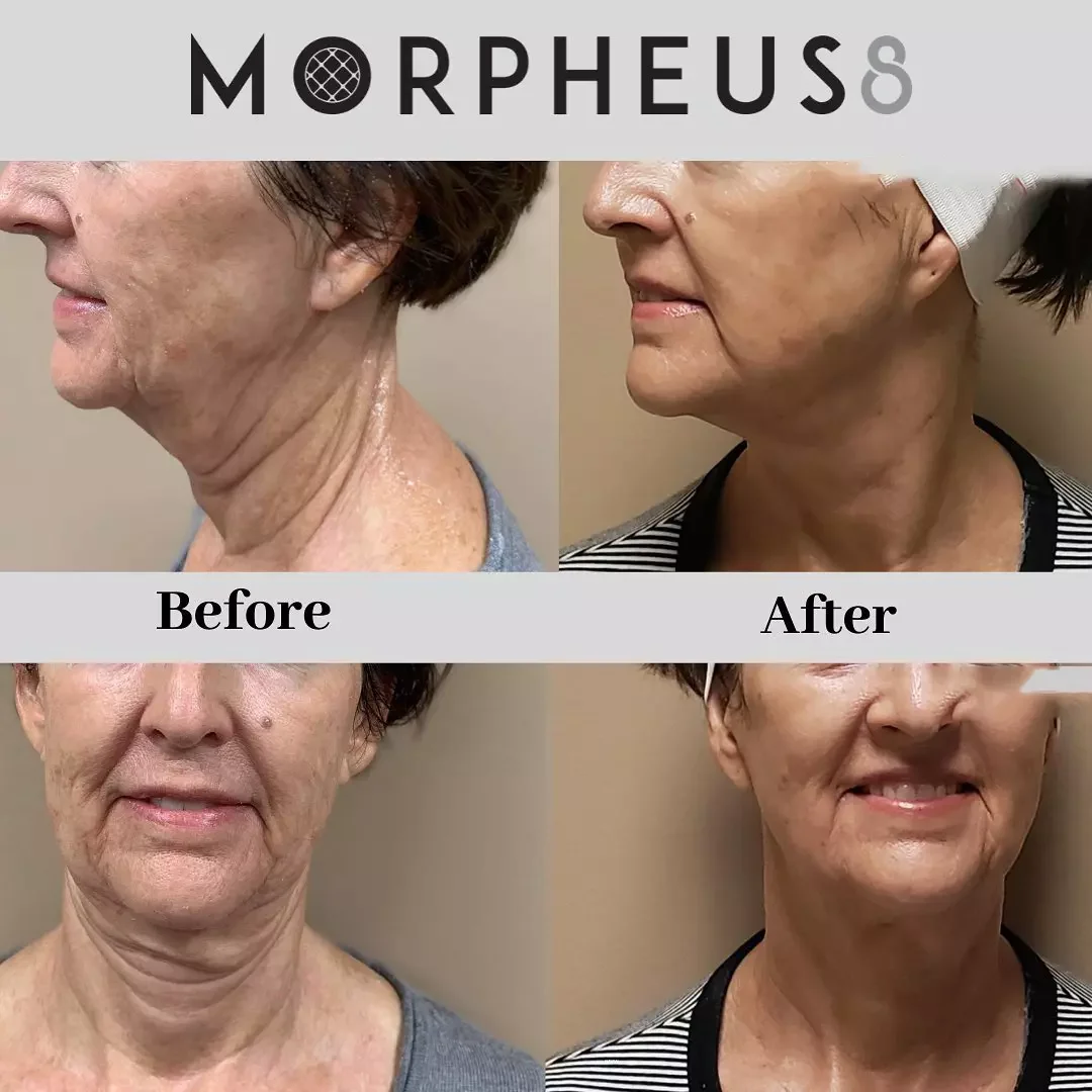 Morpheus8 Body Contouring Raleigh NC: 25 Powerful Benefits, Costs & Results (2025 Guide)