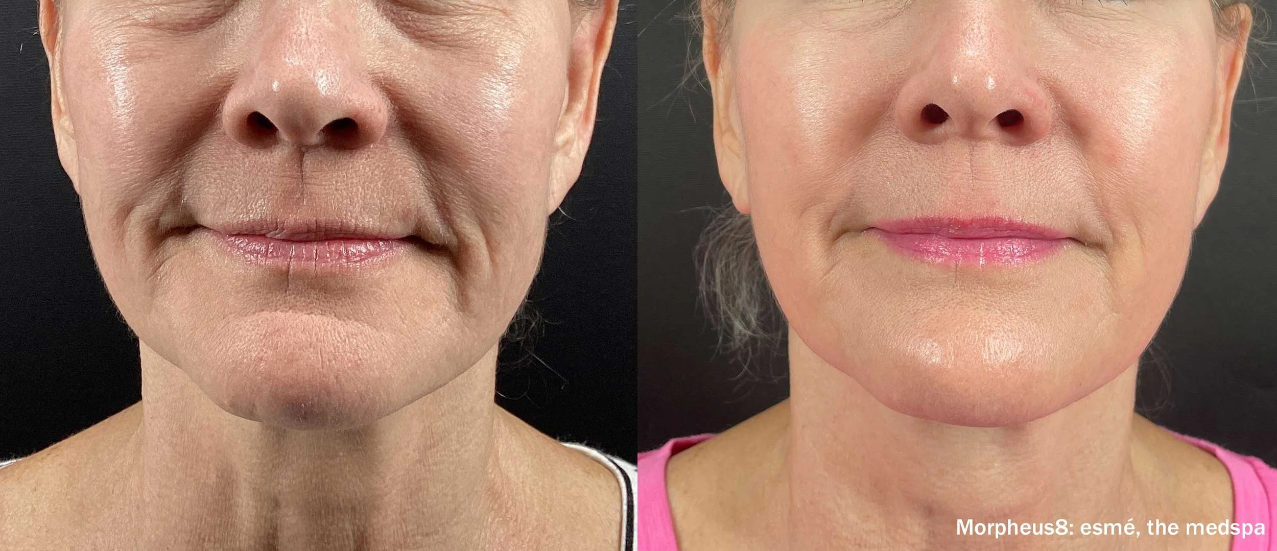 67c24289ddf2a1b1432bd479_EsmeMedspa_Morpheus8_Before_After_4Treatments_Front-TM.jpg