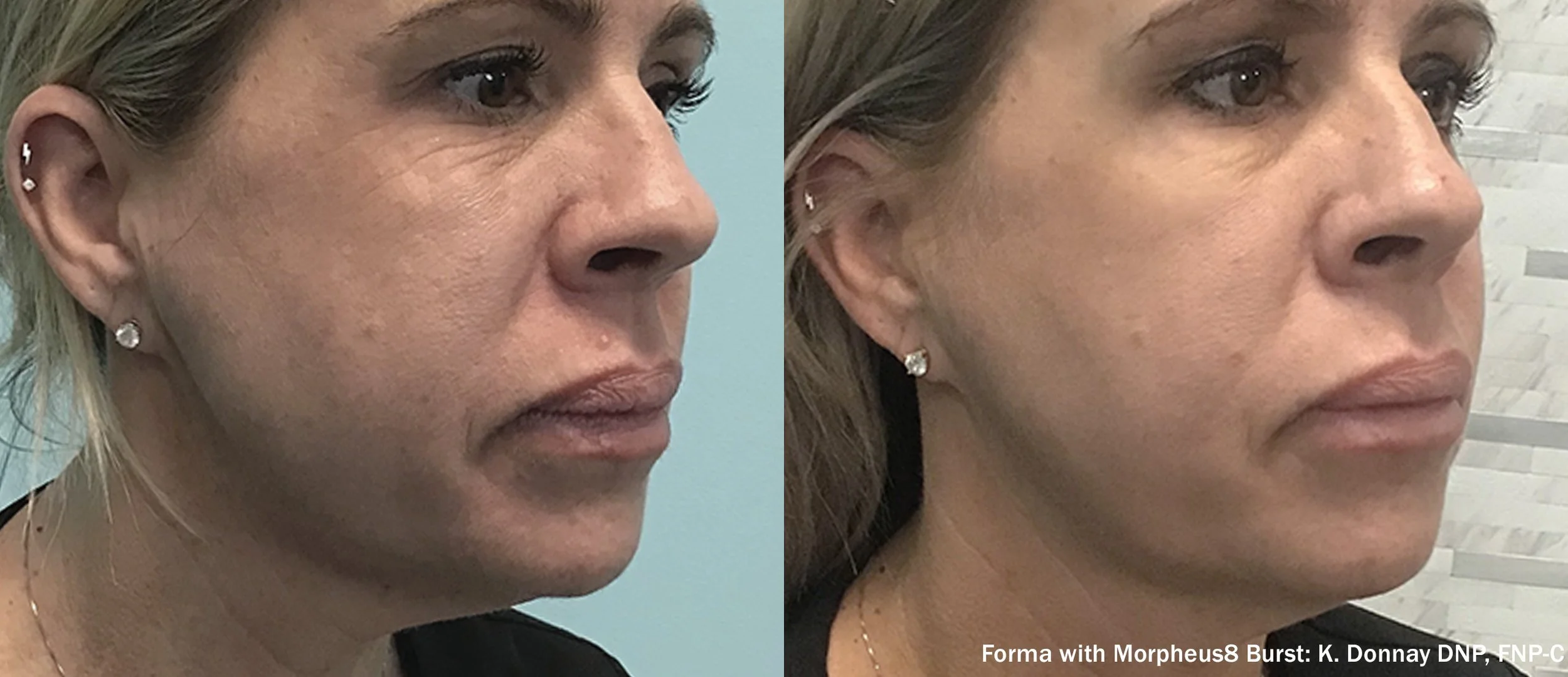 Morpheus8 body contouring before & after Raleigh NC radiant skin solutions for both genders