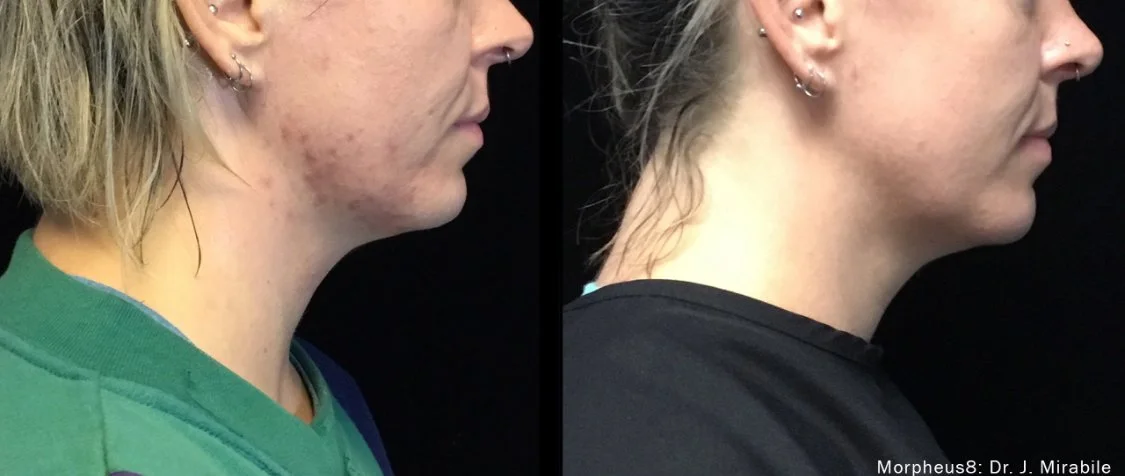 Radiant skin solutions Raleigh NC Morpheus8 before & after acne scar smoothing