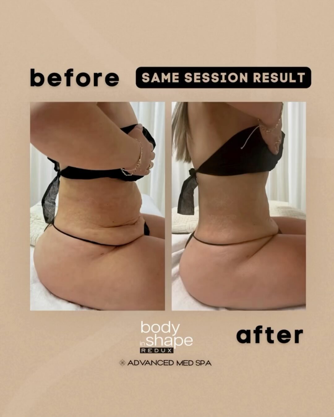 BODY IN SHAPE TRANSFORMATION 🤩⁠
Take a look at the difference in this beautiful patient after only ONE session of Body in Shape &mdash; a firmer, flatter tummy, and a more defined figure! ⏳⁠
⁠
👉🏼 Body in Shape is our protocol that&rsquo;s unlike A