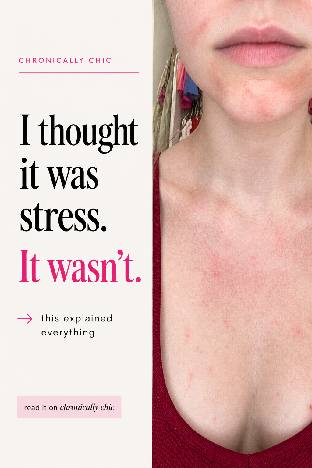 What Systemic Nickel Allergy Syndrome Actually Looked Like For Me
