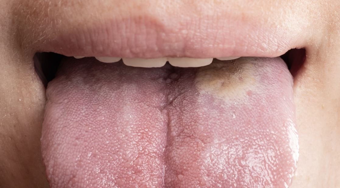 Oral Cancer: signs, symptoms, treatment, and prevention