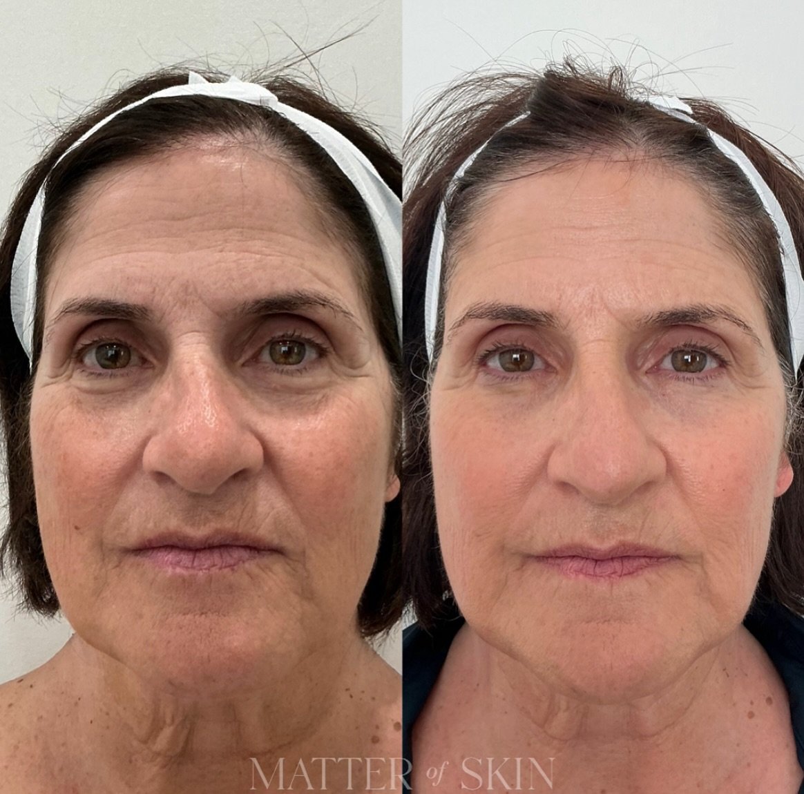 No Botox. No filler. Just 𝑭𝑹𝑨𝑿!  An incredible alternative for those who are not interested in injections. 𝑭𝒓𝒂𝒙𝒆𝒍 𝒍𝒂𝒔𝒆𝒓 therapy helps to improve fine lines, wrinkles, skin texture, and pigment for a more youthful appearances 

Results 