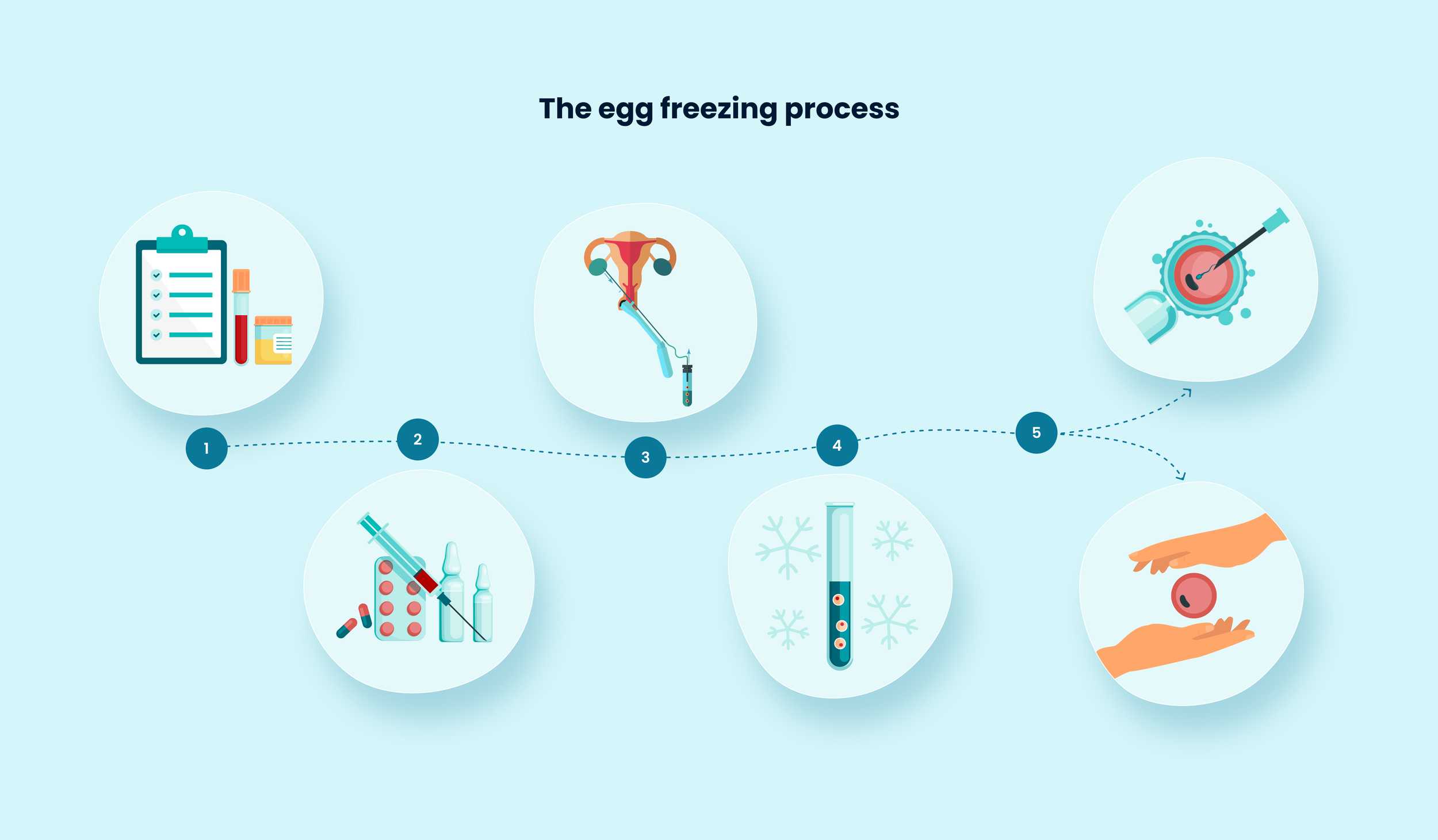 Infographic showing the 5 stages of the egg freezing process