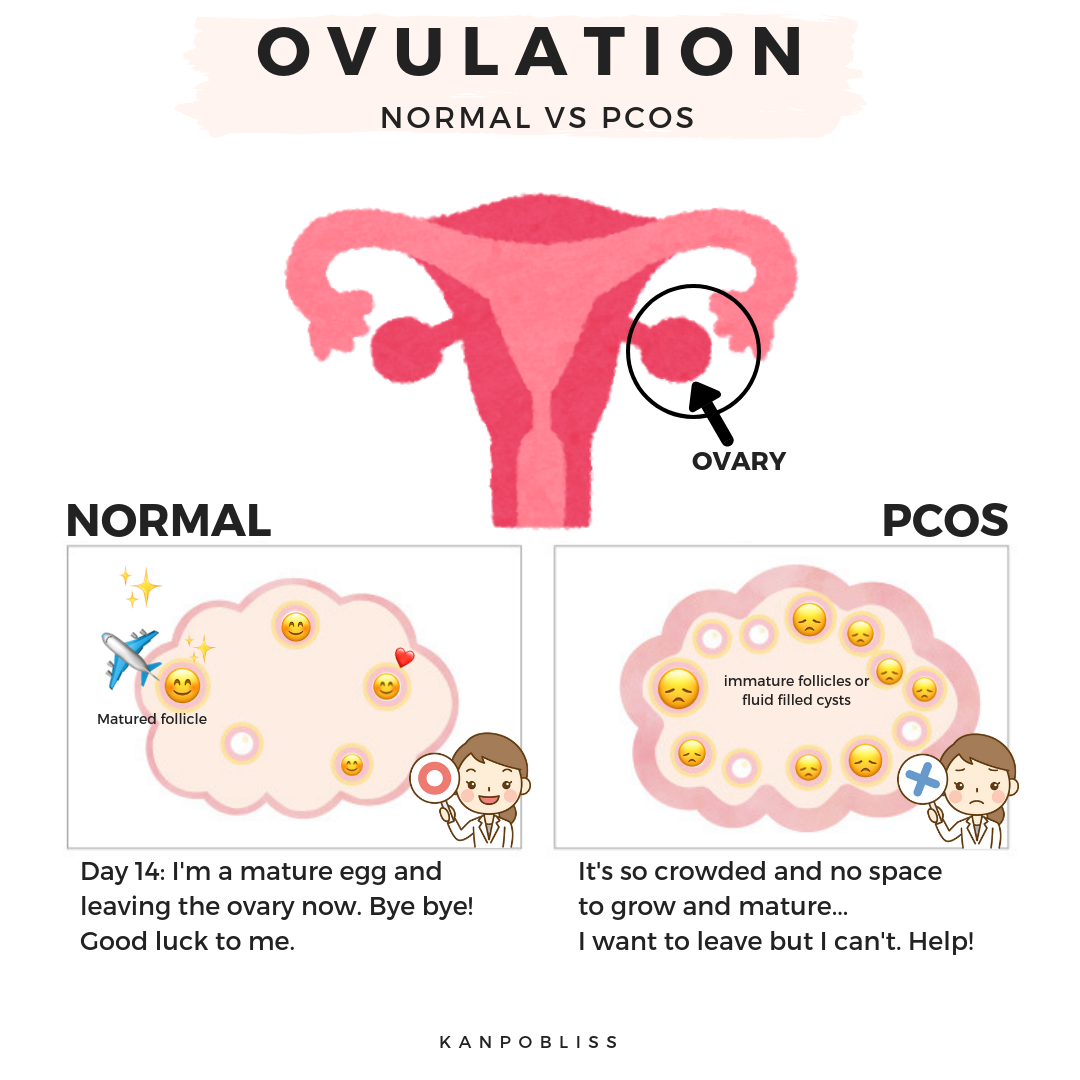 What is PCOS? — Kanpobliss TCM