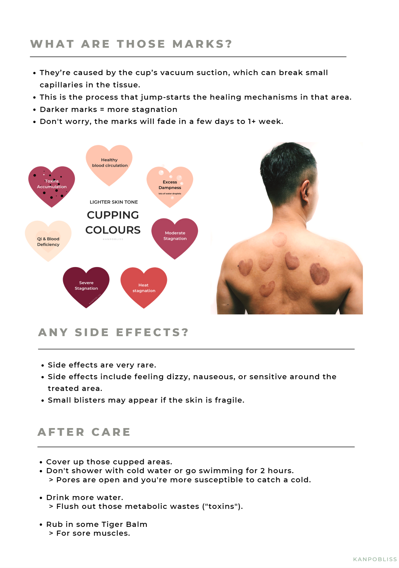 TCM Cupping therapy — Kanpobliss TCM