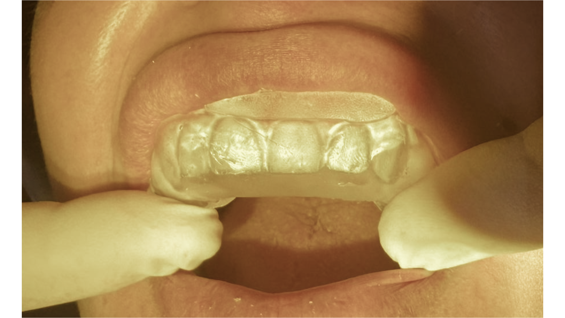 Image showing custom-made stent for composite bonding