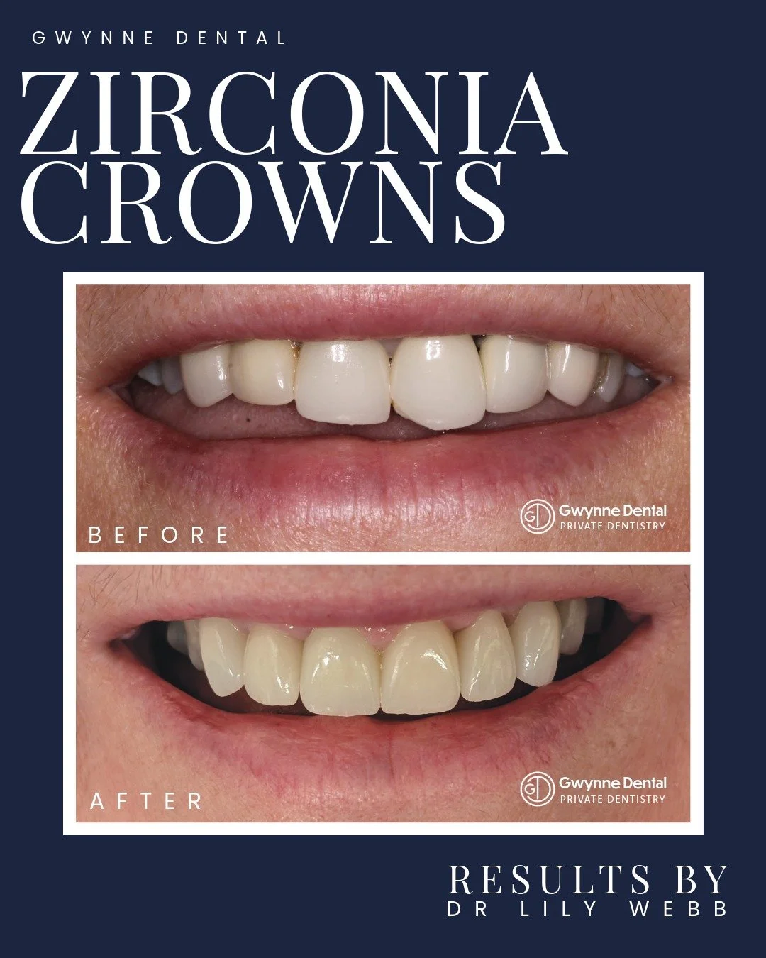 Starting 2026 off with an incredible transformation by Dr Lily Webb.

These old, bulky, broken porcelain-bonded crowns were replaced with a new set of zirconia crowns. 
Our patient wanted her teeth to be a more natural shape and colour, and to give h