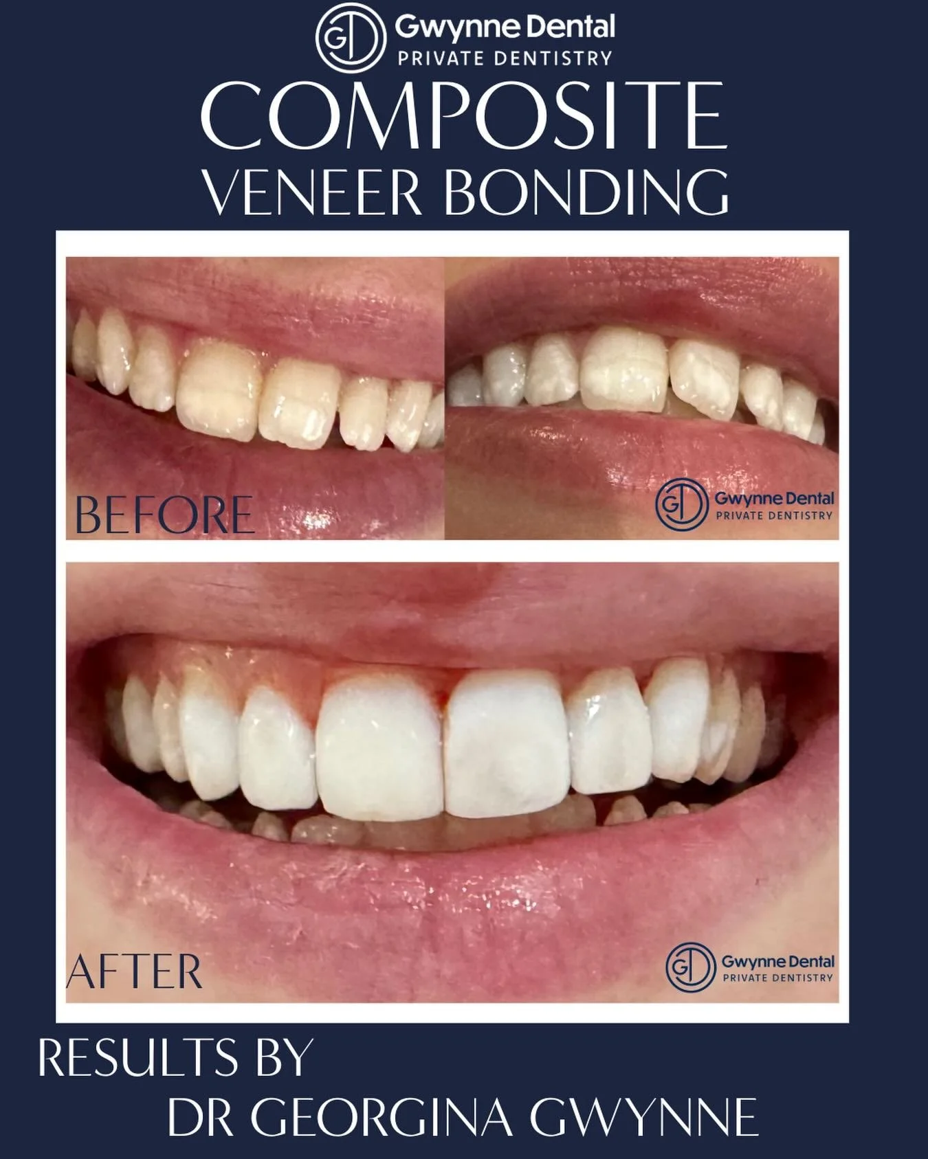 😁Confidence starts with a smile😁

🦷Thinking about enhancing your smile?🦷
Composite veneer bonding is a genital and effective option to improve tooth shape and appearance. Designed to enhance the shape, colour and symmetry of your smile! A subtle 