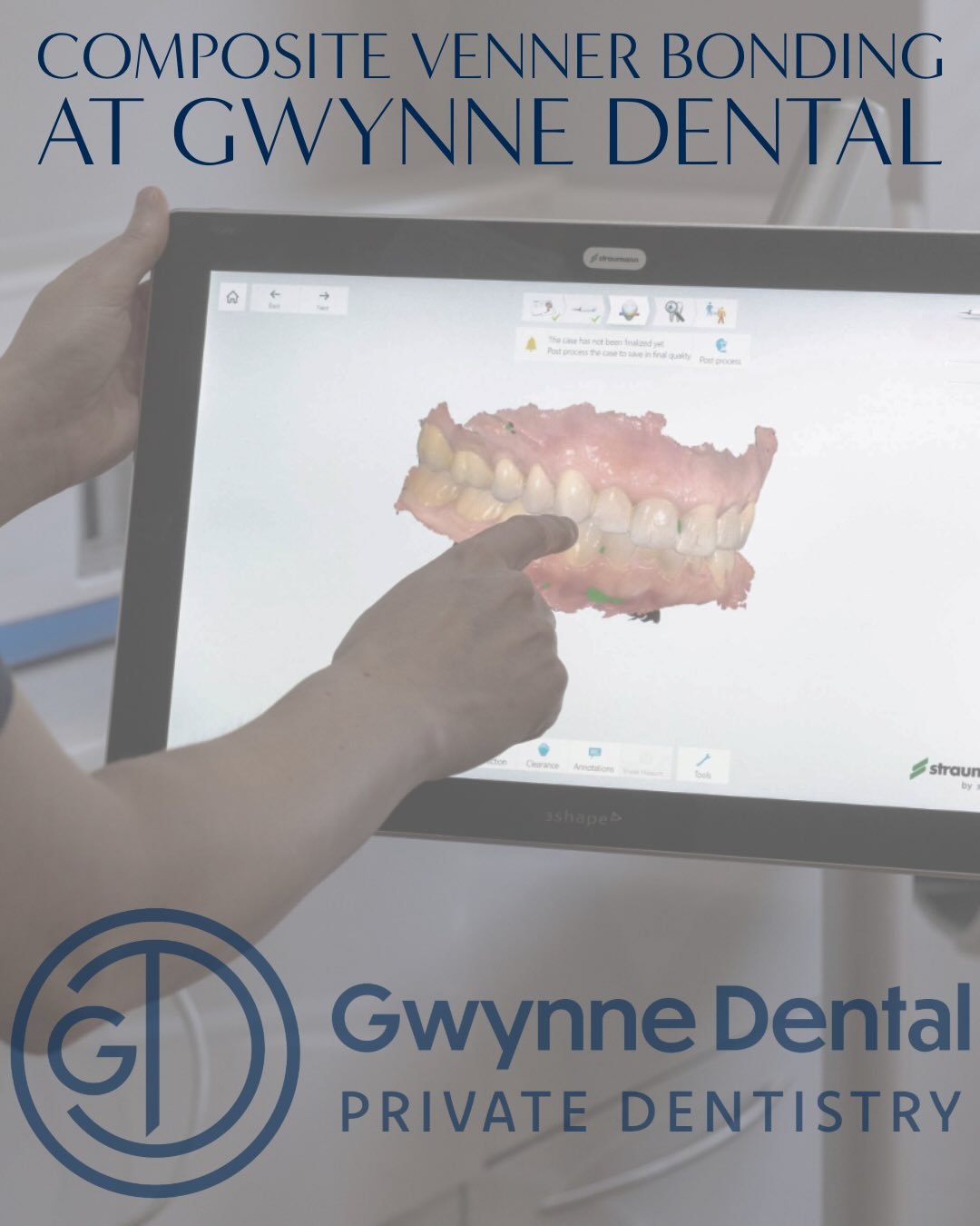 ⭐️Creating beautiful smiles with composite bonding⭐️

Composite bonding is a gental and effective way to enhance your teeth with natural- looking results!

➡️Swipe to see the transformation ➡️

If you are interested in transforming your smile, please
