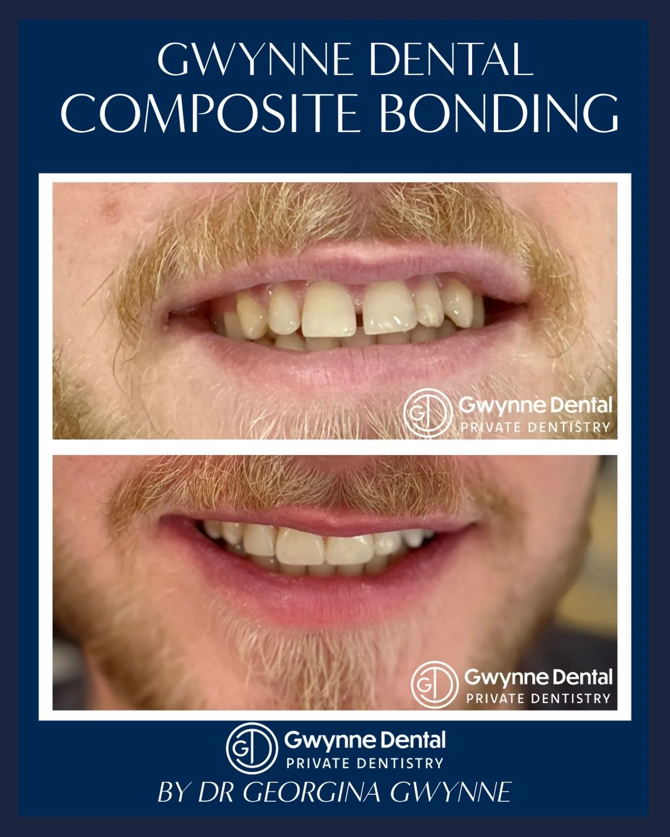Another excellent Composite Bonding case by Dr Georgina Gwynne!😄

For this patient, Dr Gwynne has utilised minimally-invasive composite bonding techniques to close the gap (a diastema) between the front teeth. 
The results speak for themselves! What