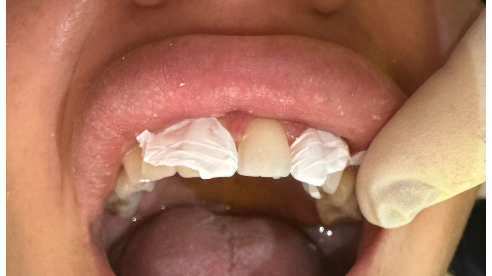 Image showing mid-way through composite bonding