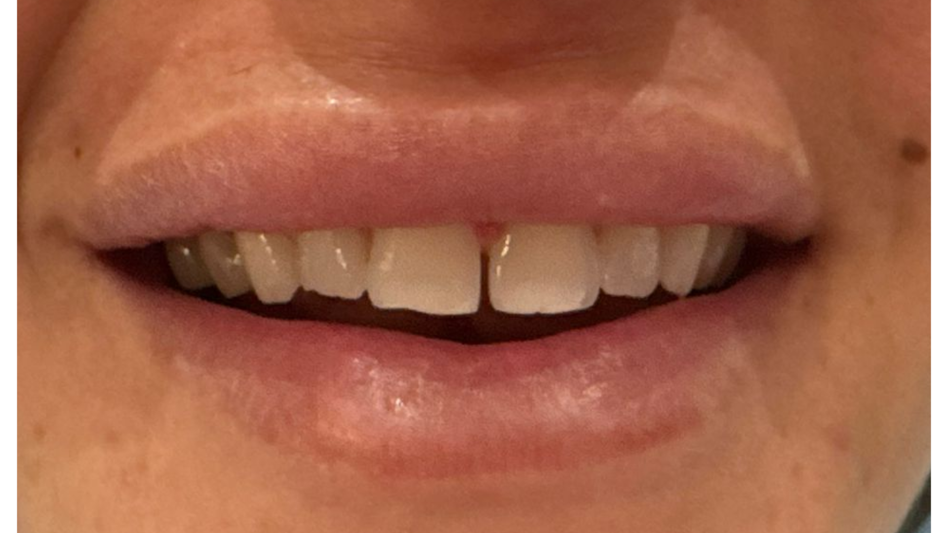 Image showing teeth before composite bonding