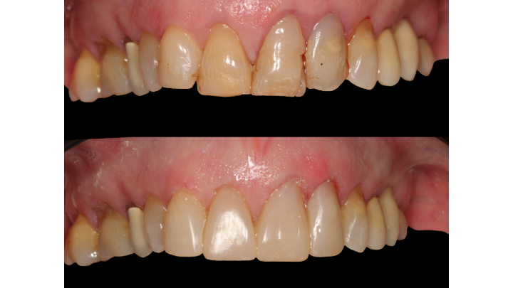 Image showing before and after composite veneer bonding