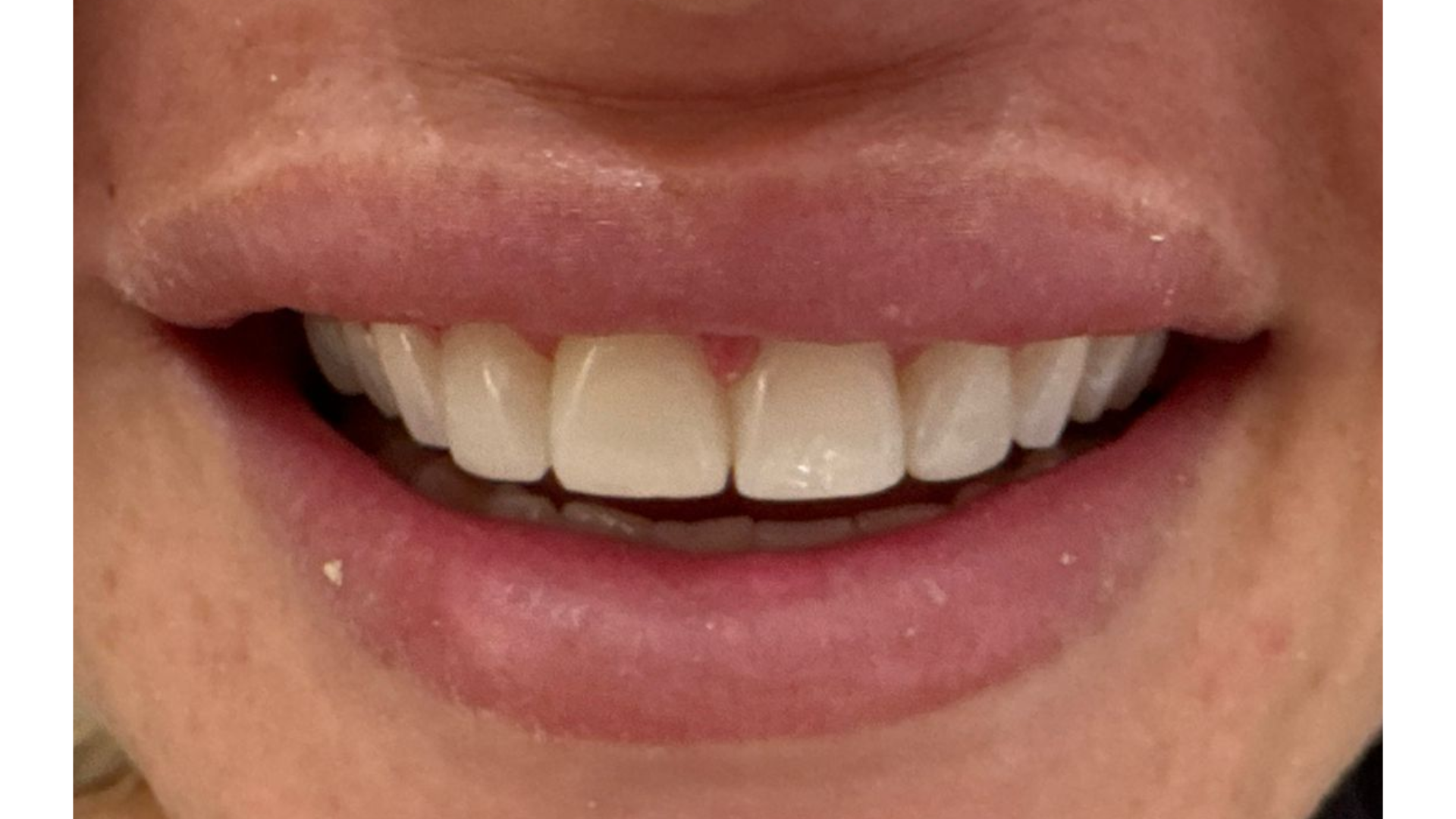 Image showing after composite bonding from the front