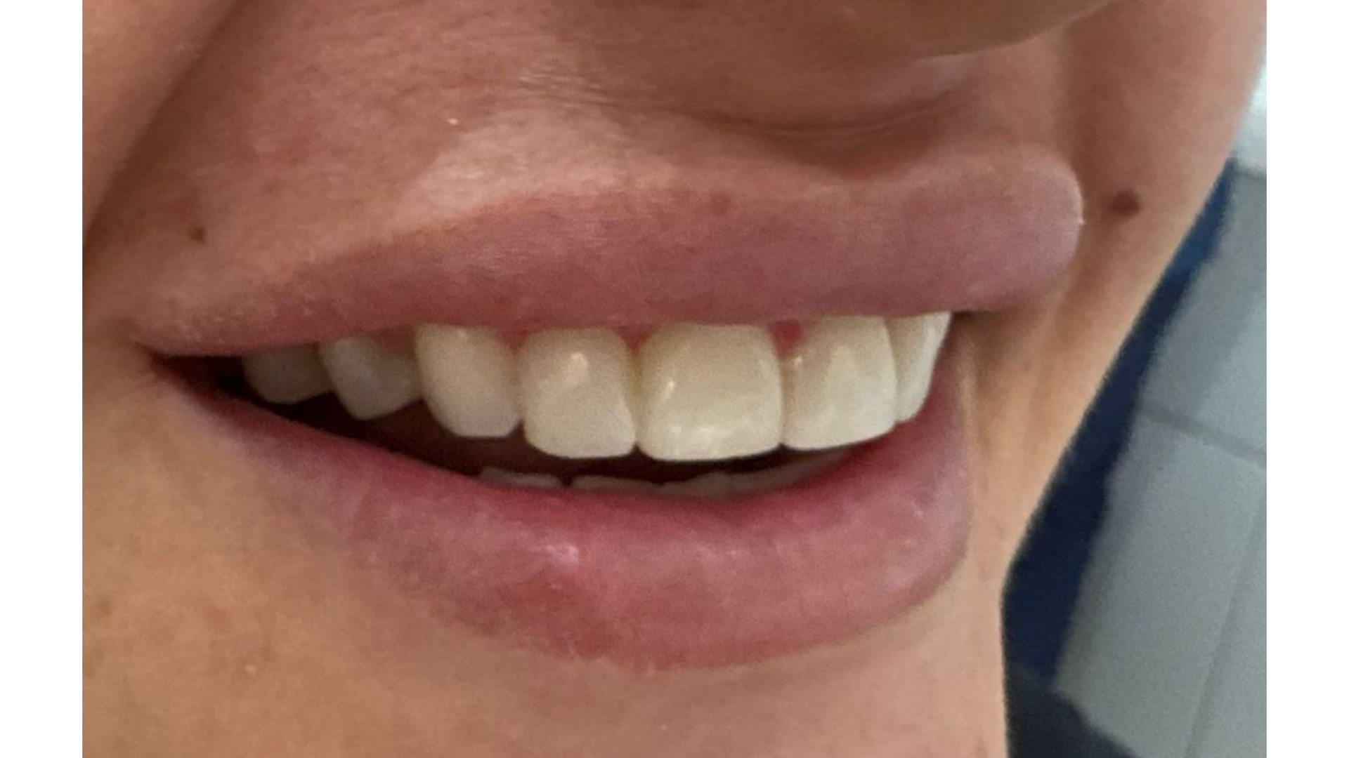 Image showing composite bonding results right side