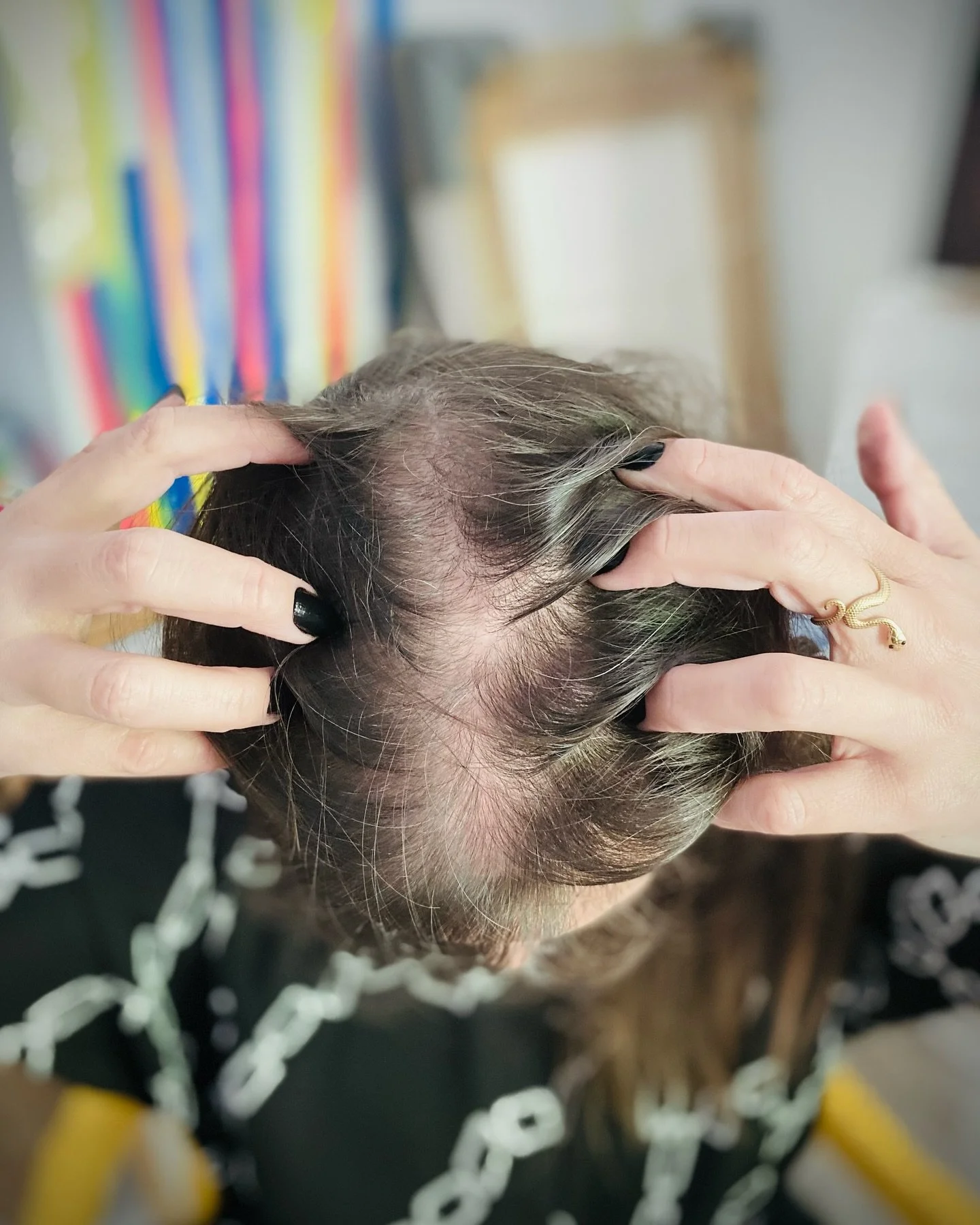 I was diagnosed with Androgenetic Alopecia Stage 2 at the age of 15, just like many others. Over the past 29 years, I have tried various treatments, but nothing has truly worked for me. In 2016, I decided to accept my condition and live with it. This