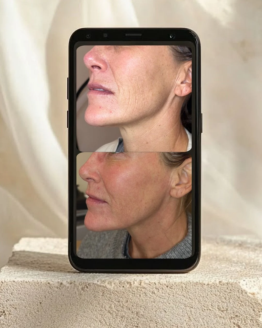 One eCO2 treatment. One week later. Already transforming.

Swipe to see the dramatic difference just ONE WEEK after a single ablative eCO2 treatment (performed by @aesthetician.madison) - and this isn&rsquo;t even her final result yet.

Notice the si