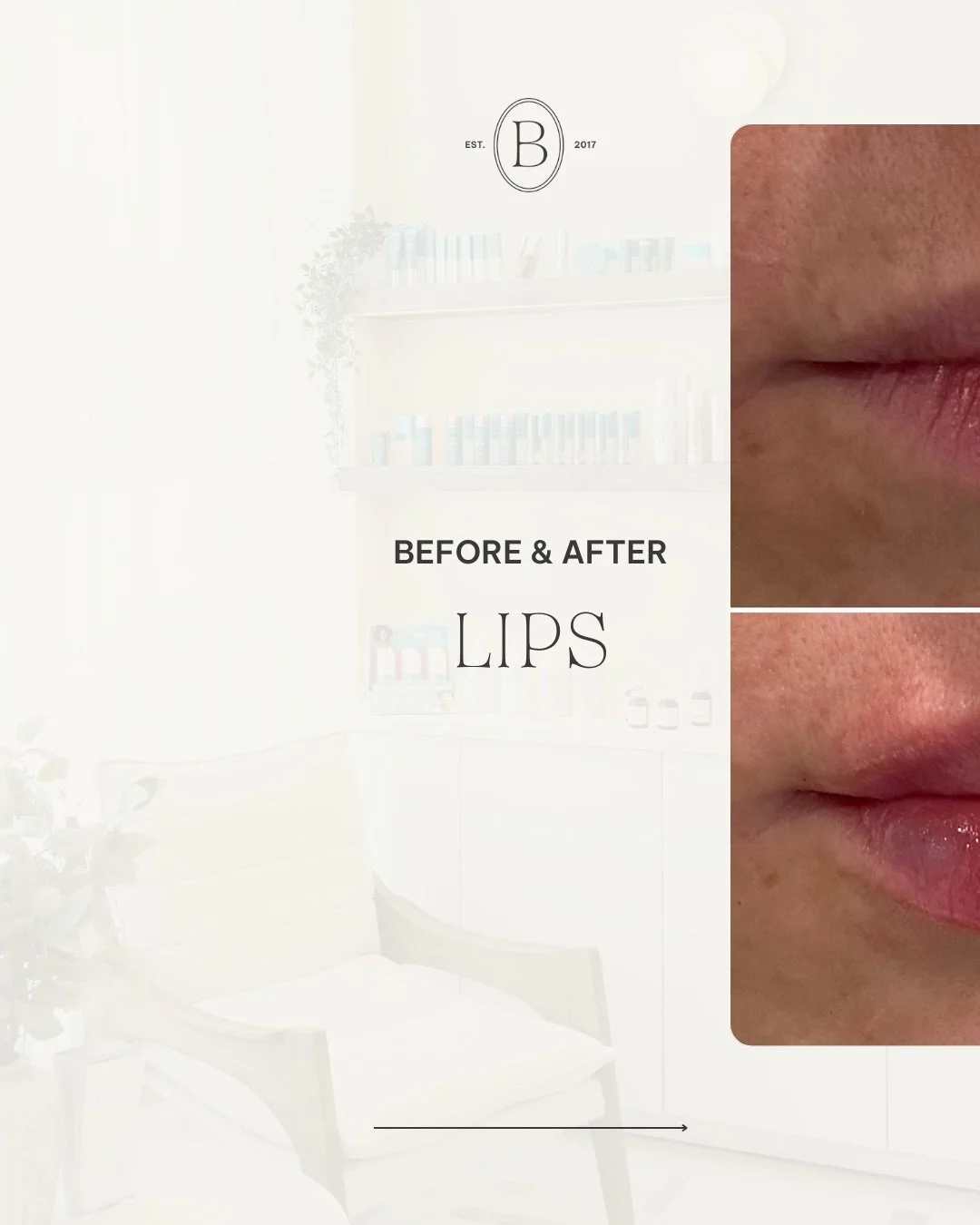 Your lips. Elevated.

Natural. Pillowy. You, just more.

At Bonita, we believe in results that turn heads, not ones that raise eyebrows. Our lip filler approach is all about enhancing your natural shape, restoring volume, and giving you lips you&rsqu