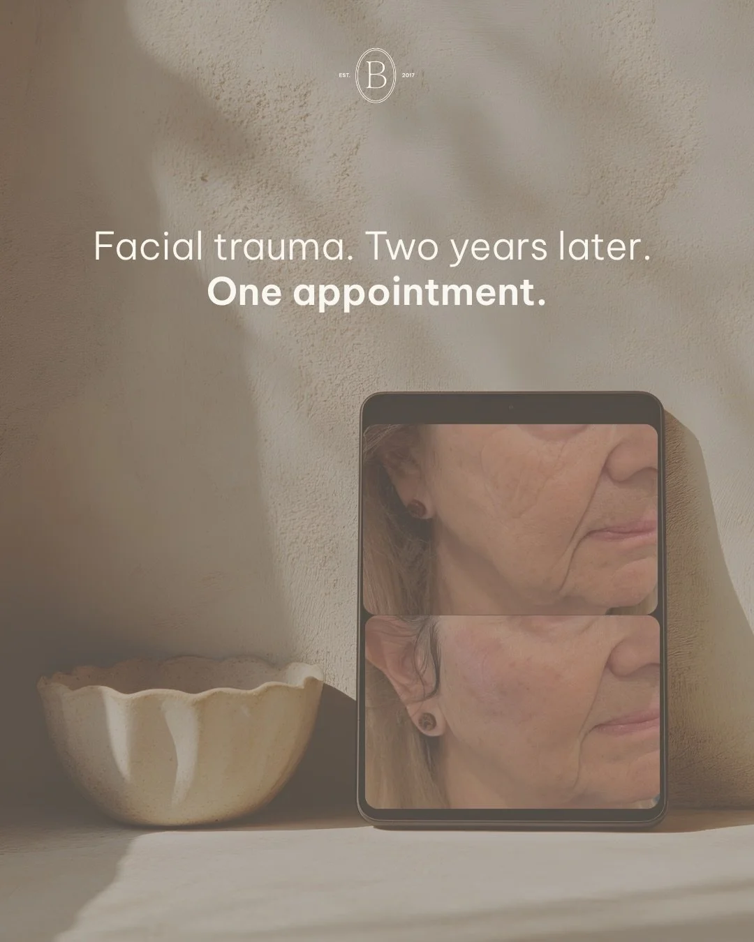 Facial trauma does not always heal the way we expect it to. 🤍

Volume loss, tissue damage, and visible depressions can linger long after the injury itself is gone. And for many people, so does the self-consciousness.

What you see in these photos wa