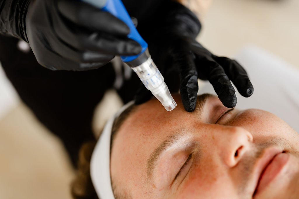 From Scars to Smooth: The Microneedling Protocol That Works With Your Story