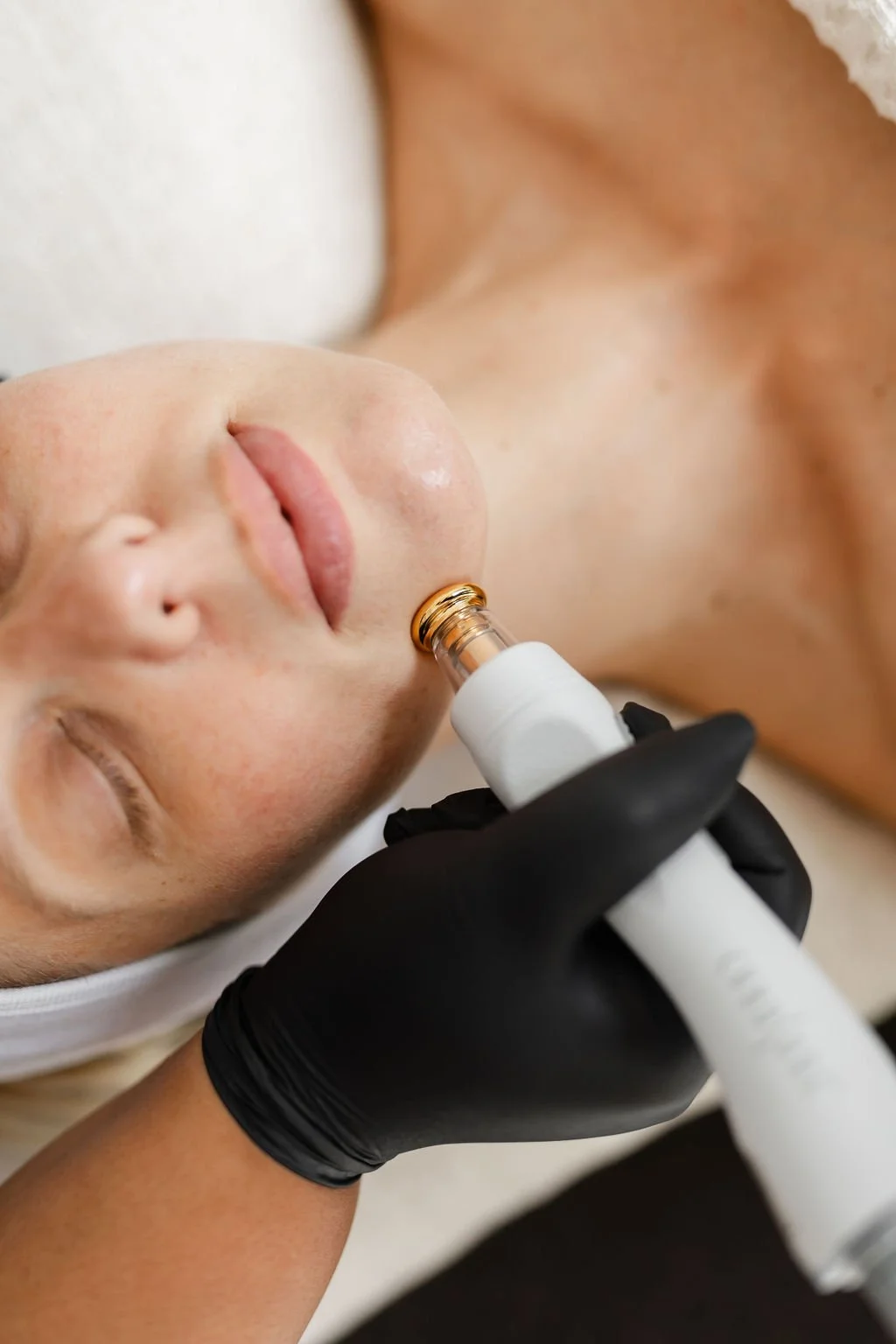 The Potenza Powerhouse: Why It’s Our #1 Treatment for Acne Scars, Aging & Skin Laxity